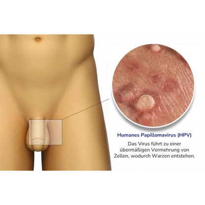 IntimaCure™ – Schnellwirkende Genitalwarzen-Entferner für sensible Haut