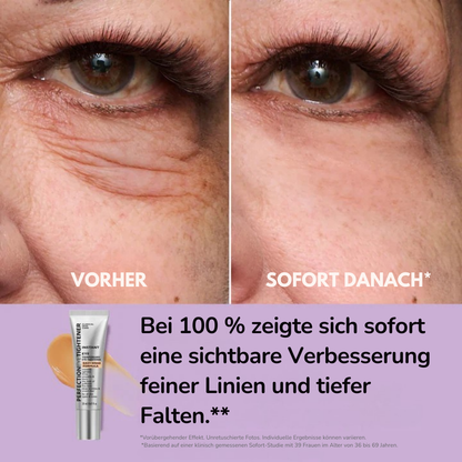 Kléra™ – Sofortige Straffungslösung für den Unteraugenbereich