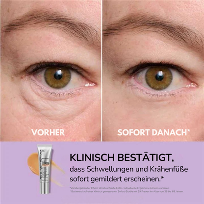 Kléra™ – Sofortige Straffungslösung für den Unteraugenbereich