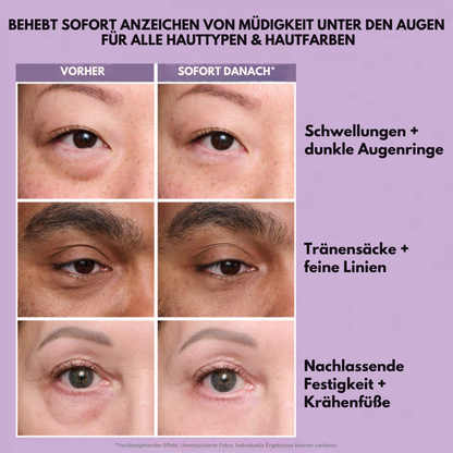 Kléra™ – Sofortige Straffungslösung für den Unteraugenbereich