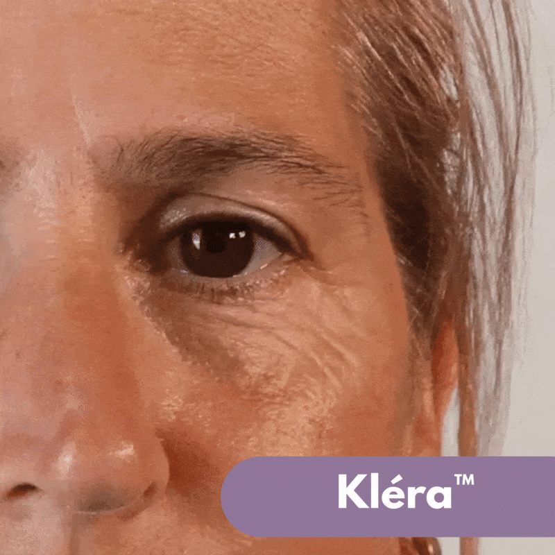 Kléra™ – Sofortige Straffungslösung für den Unteraugenbereich