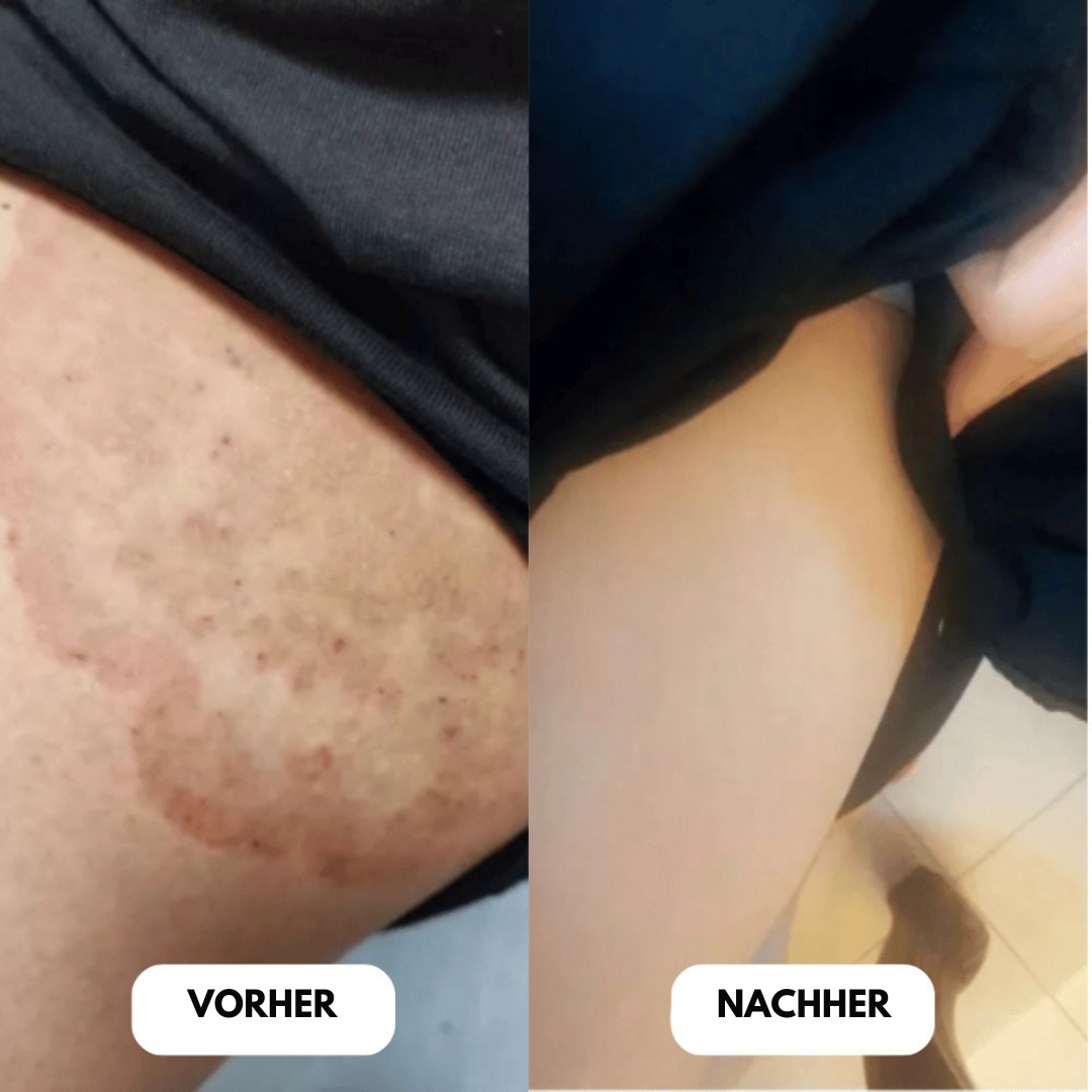 SensiVive™ Antibakterielle Creme | Stoppt Juckreiz & Beseitigt Bakterien Schnell!