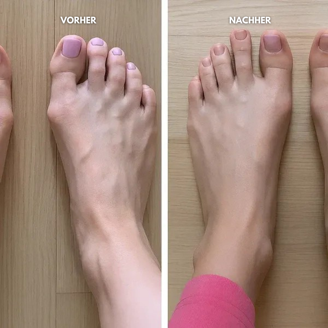 Velnix™ Schiene | Gezielt Zehen-Ausrichtung & Hallux-Korrektor