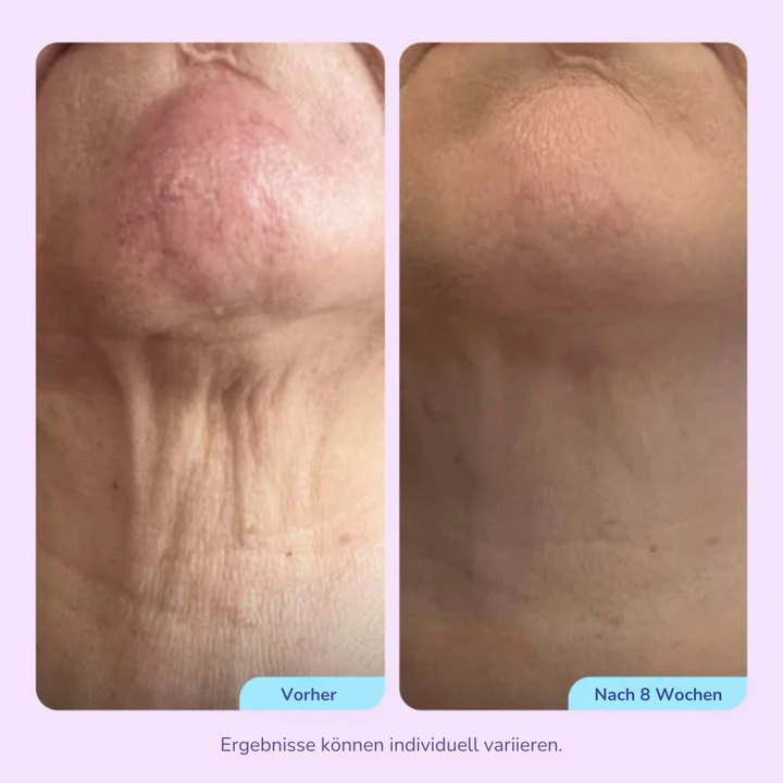 Elvéra™ – Hebt, Strafft & Formt Ihren Hals für eine Jugendlich Kontur!