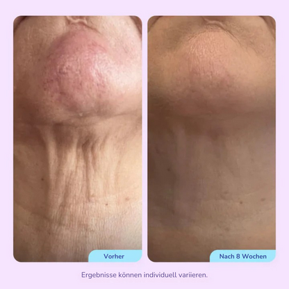 Elvéra™ – Hebt, Strafft & Formt Ihren Hals für eine Jugendlich Kontur!